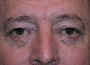 EYELID SURGERY GALLERY After