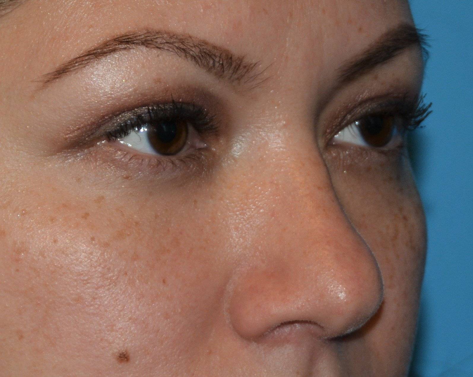 After Eyelid Surgery
