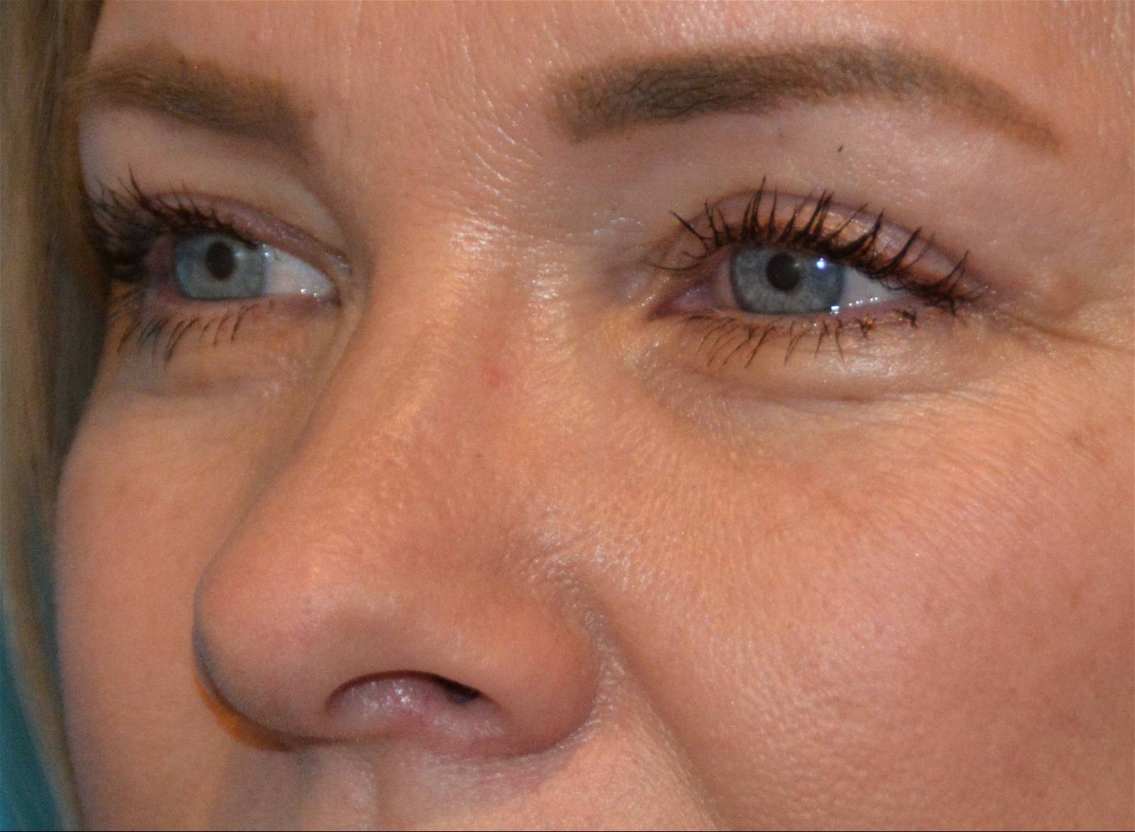 EYELID SURGERY After