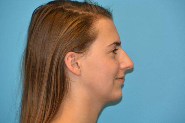 CHIN IMPLANTS GALLERY AFTER