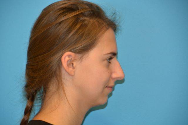 CHIN IMPLANTS GALLERY BEFORE