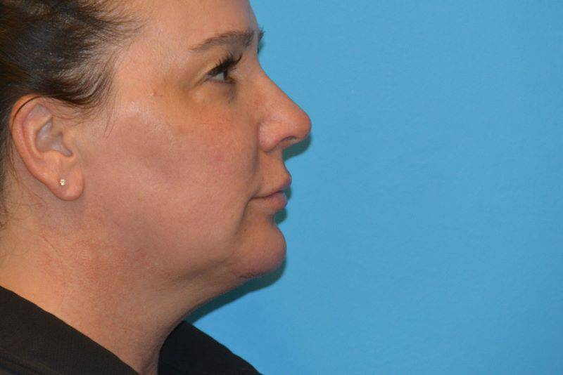 CHIN IMPLANTS GALLERY AFTER