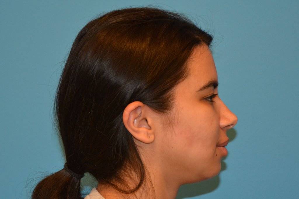 FACE AND NECK LIPOSUCTION Before