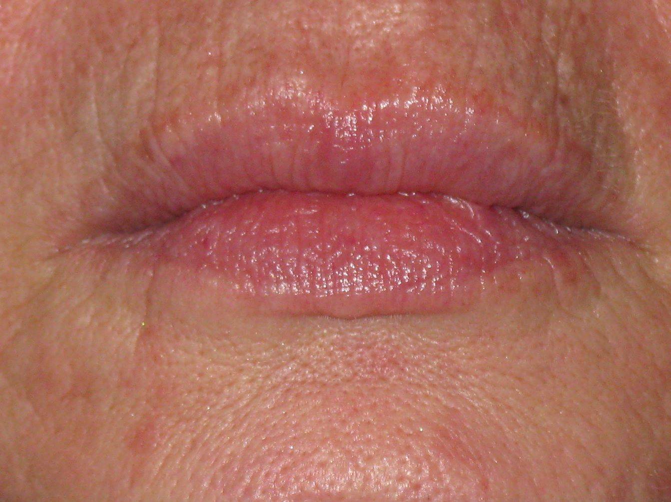 LIP LIFT GALLERY AFTER