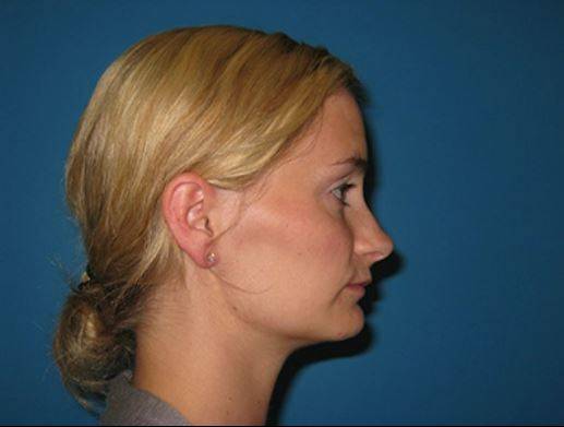 JAW SURGERY GALLERY Before