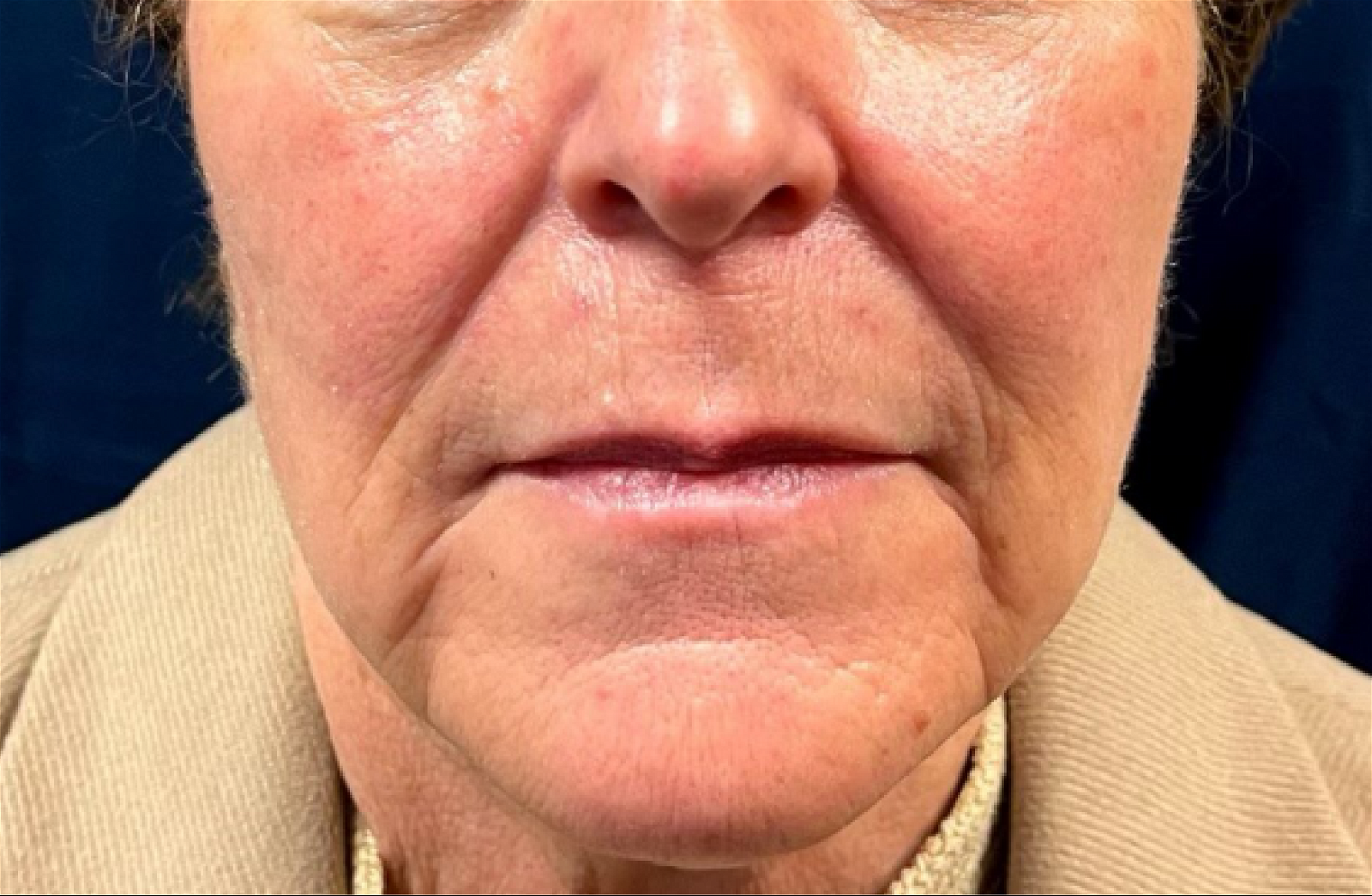 Botox Cosmetic before treatment